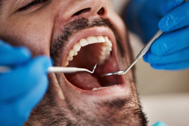 Best Knocked-Out Tooth (Avulsed Tooth) Treatment in Yosemite Lakes, CA
